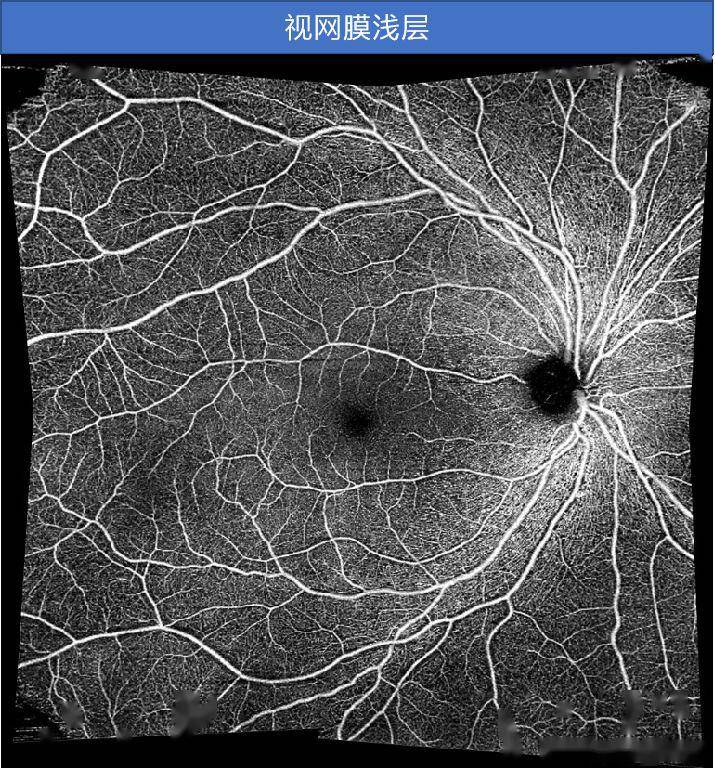 广角octa中浆病史视力0.3主诉:右眼视力下降7～8年,视物变形4月余.