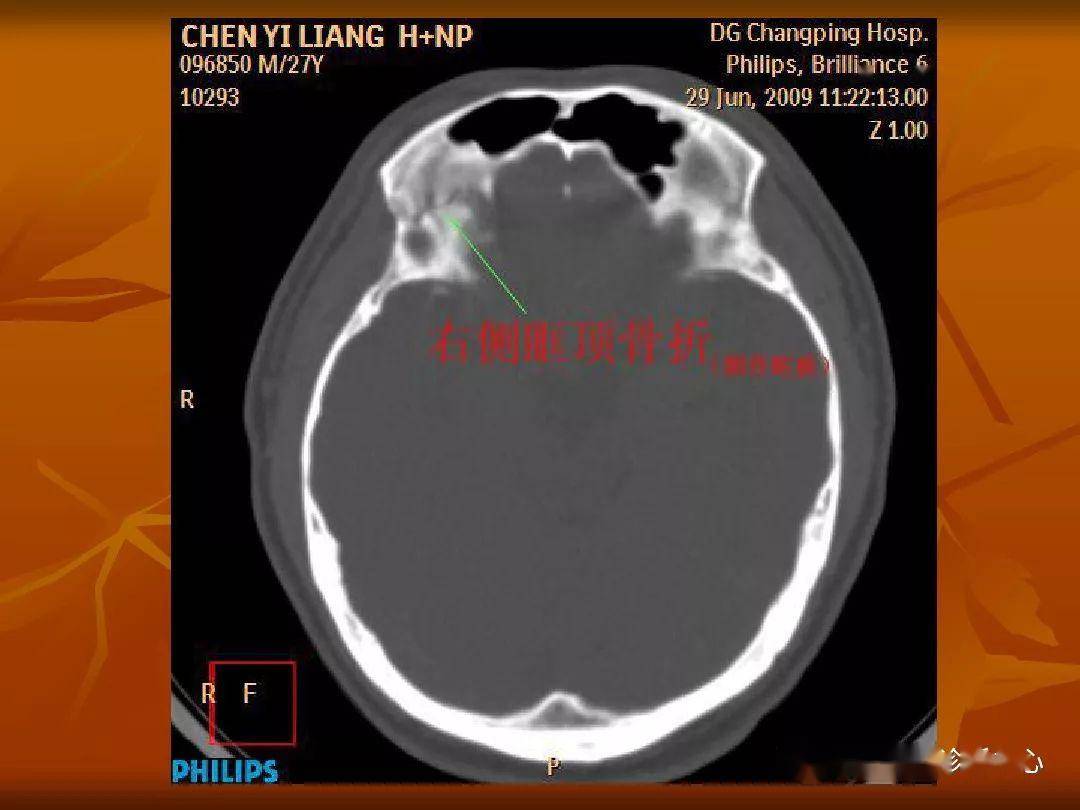 顱骨外傷性骨折ct診斷