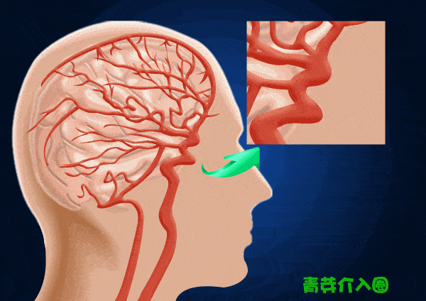 颅内动脉瘤,又被称之为脑袋里的不定时炸弹,一旦破裂出血,致死致残率