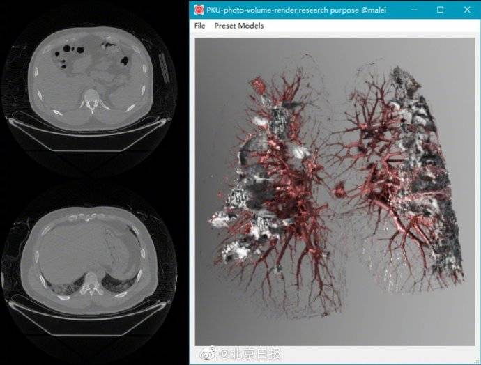 北京 大學新技術助力新冠ct診斷,肺部纖維化清晰可見