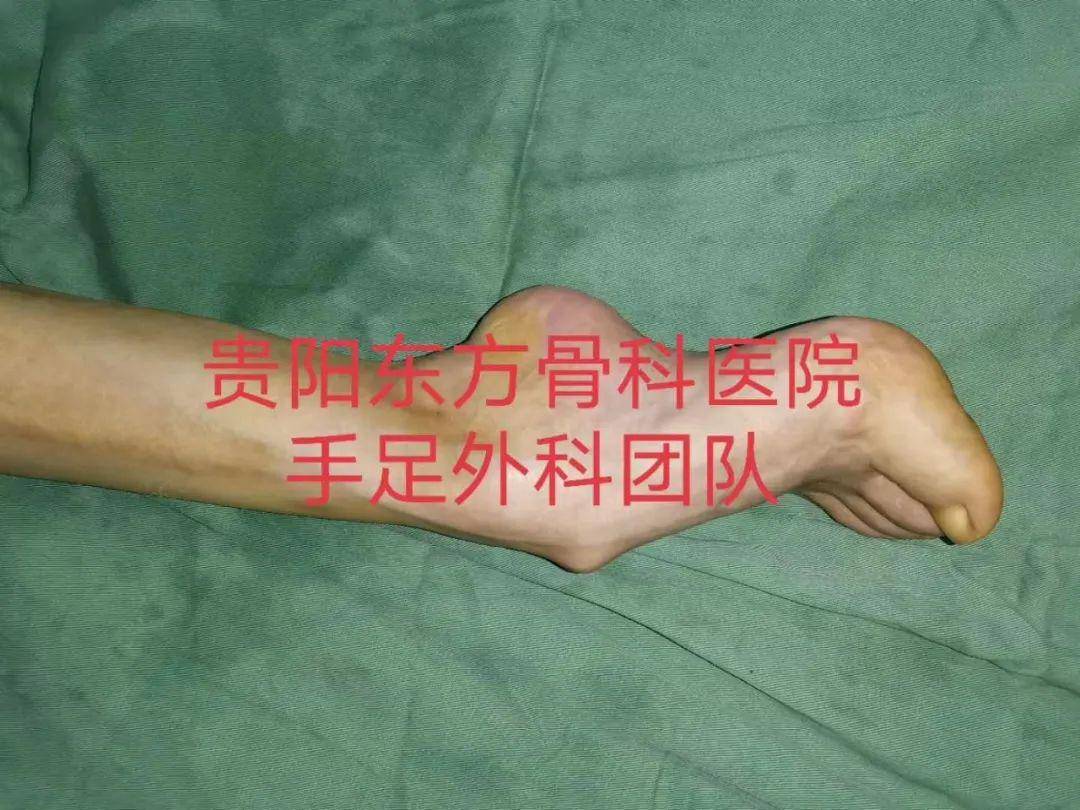 因马蹄高弓足跛行50年,手术成功矫形