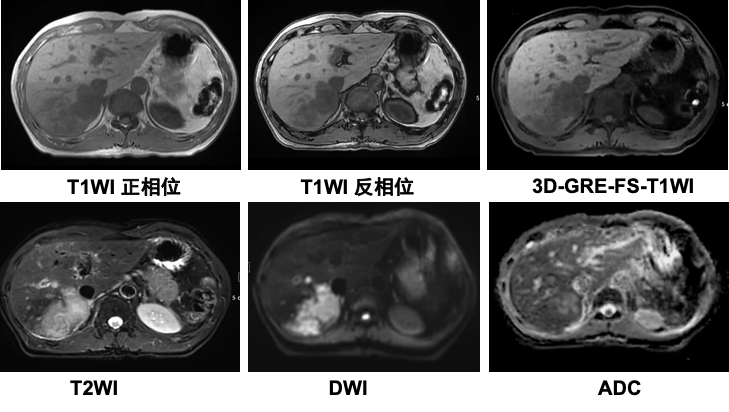 搞定这 3 个问题,零基础也能读懂腹部 mri