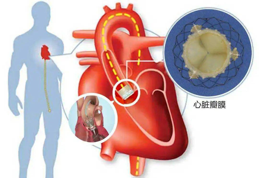 仁医新术丨洪浪团队再次独立完成2例高难度主动脉瓣置换手术