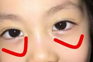 直播|上海市眼病防治中心丁琦:守护心灵之窗,关爱眼睑健康