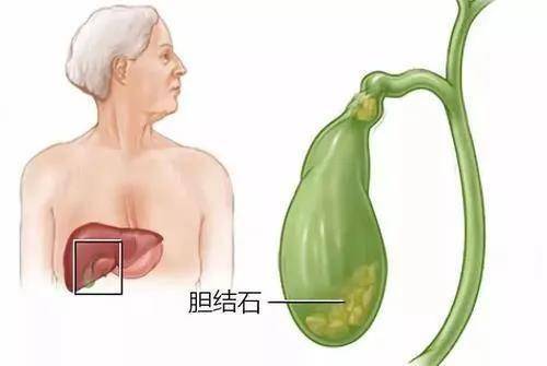 没症状的胆结石不需要治疗 胆结石症状这些误区你知道吗 胆囊