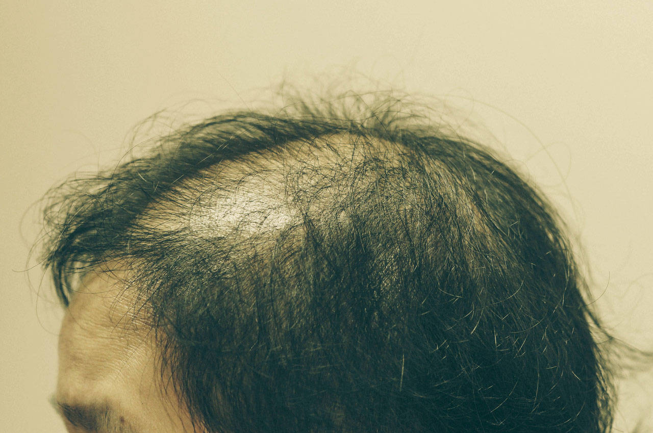这10种行为可能导致脱发