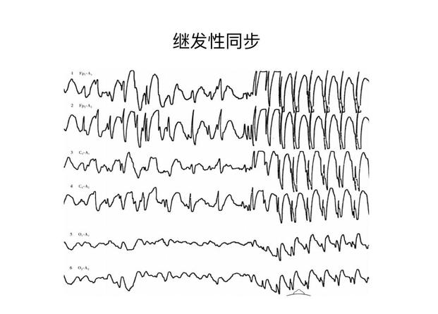 儿童正常脑电图图片