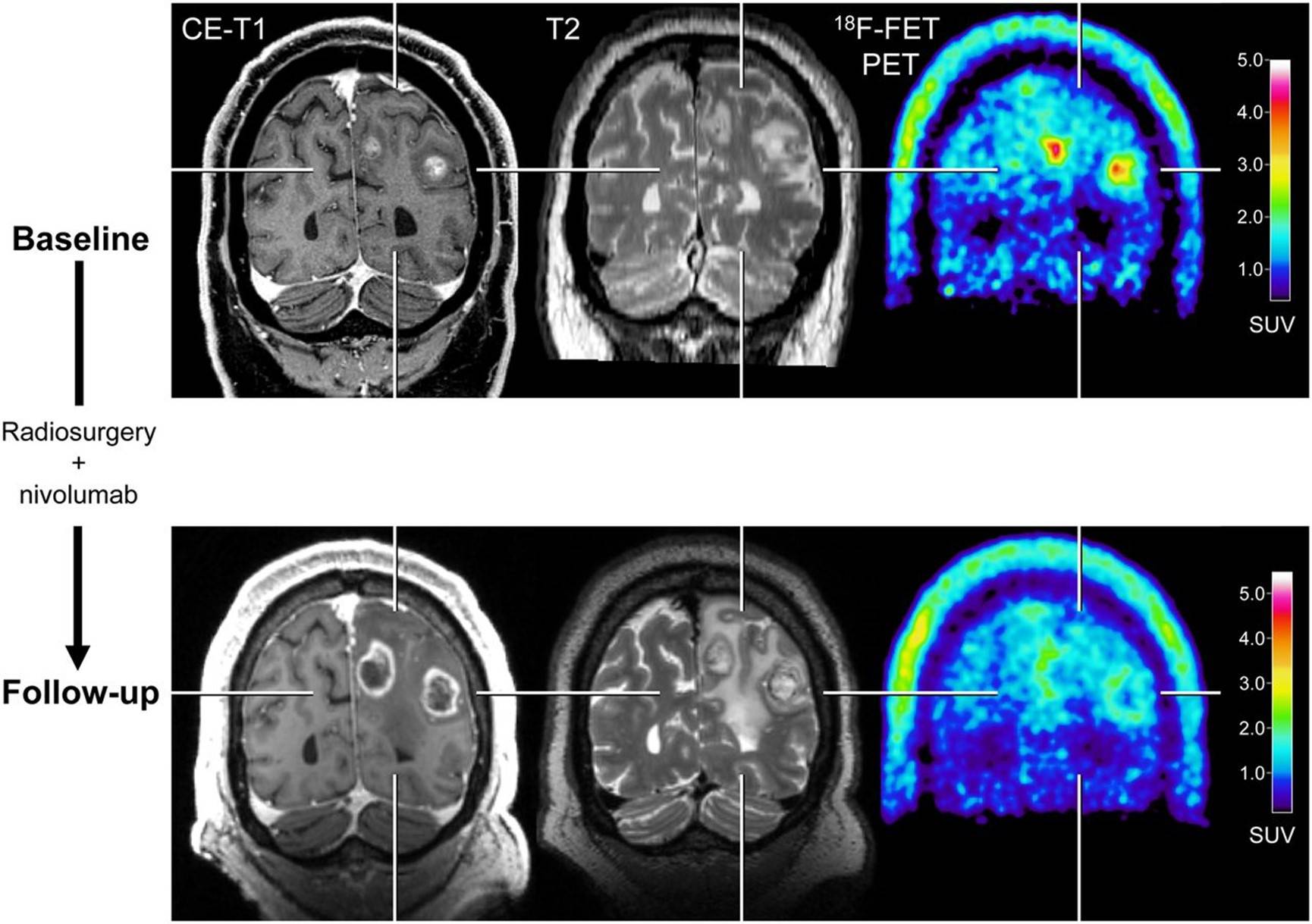 pet显示代谢活性显著降低(tbrmean,6128%),尽管根据irano标准,mri