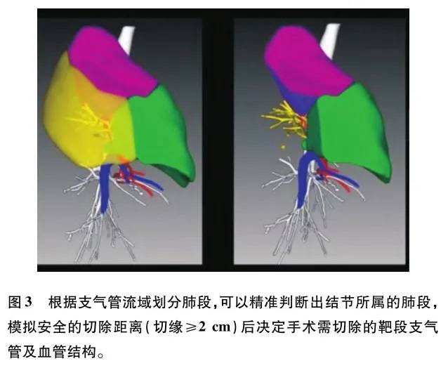 以最小代价救治肺癌患者 分享三家医院精准肺段切除精选病例及学术论文 手术