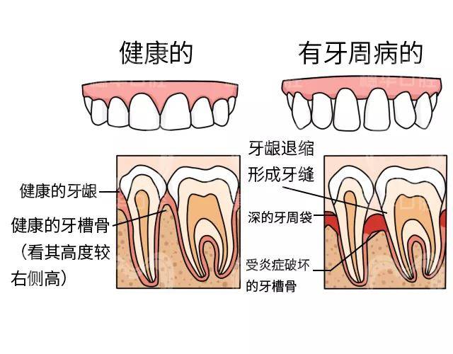 牙周病与蛀牙不同,蛀牙可通过修补的方式来改善,但是牙槽骨一旦吸收就