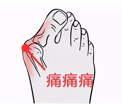 广药三院怎么做才能远离拇外翻以及脚趾问题