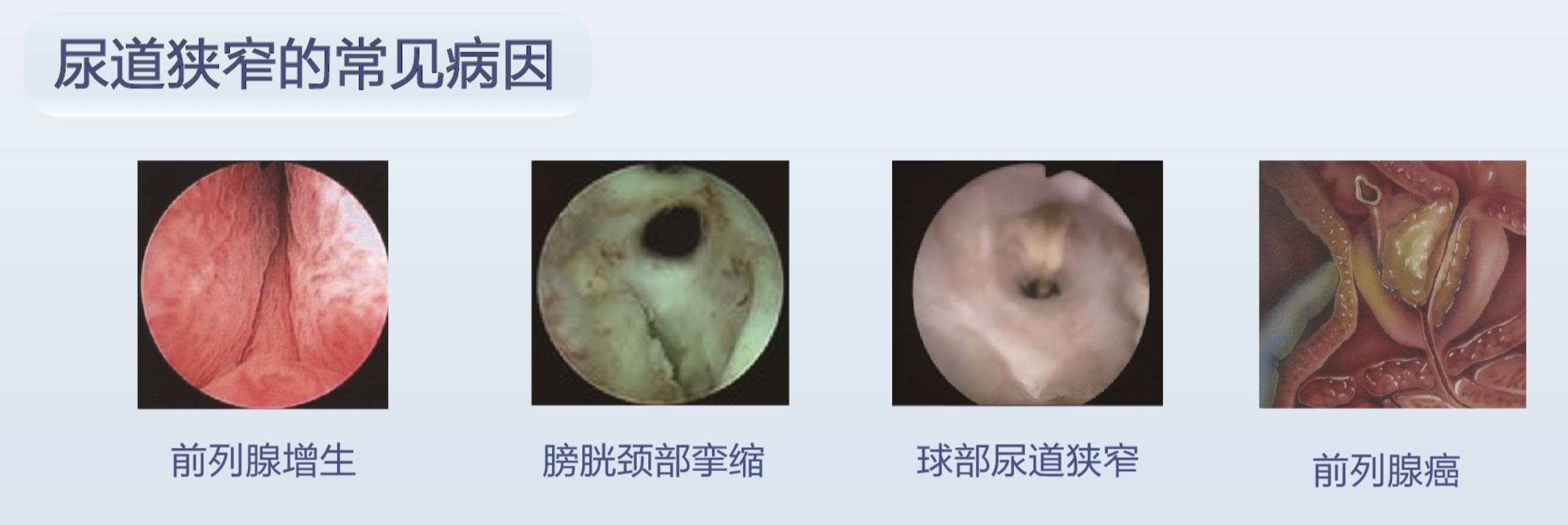 尿道狭窄患者福音来了 Allium