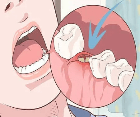 拔牙的注意事项