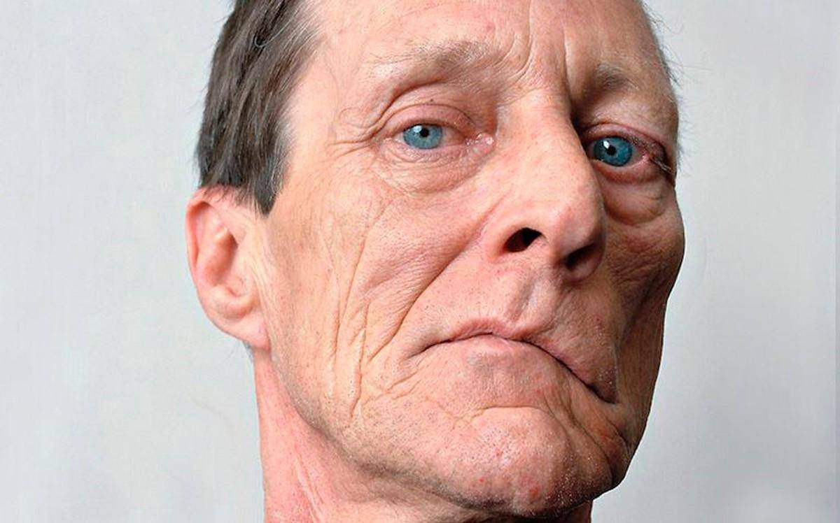 夏季面瘫患者增多年轻人不容忽视