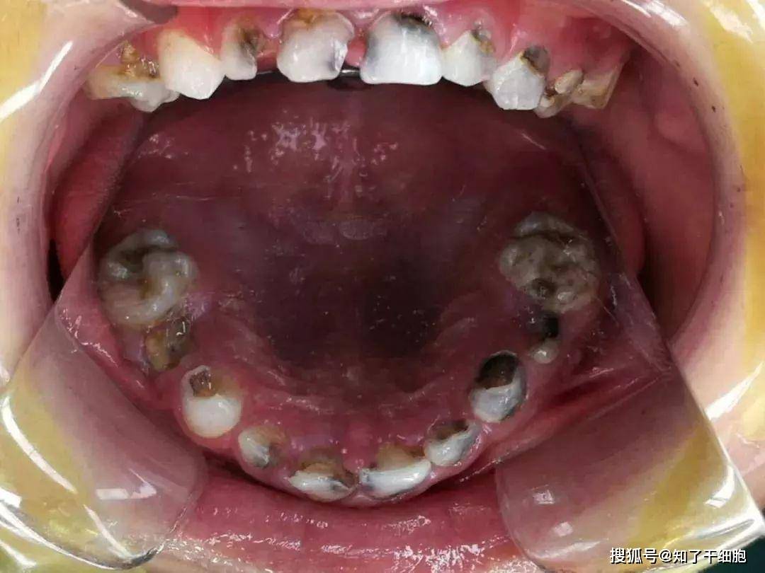 口腔和牙齿的检查,及时涂氟,根据实际情况做窝沟封闭,一旦检查出蛀牙