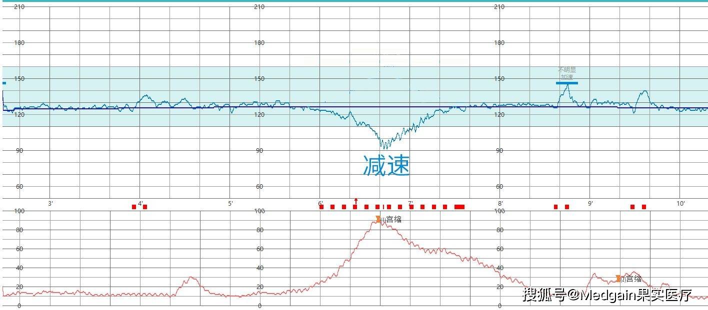 图一是一张胎心率曲线图,上2/3部分是胎心率曲线,下1/3部分为宫缩曲线