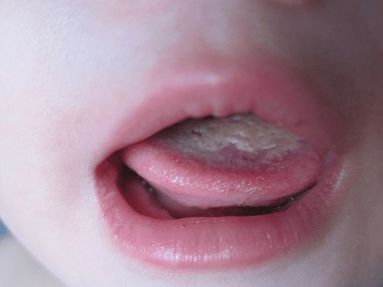 你的舌苔提示你,你身体中的邪热已经入侵地很深了,舌苔发黄越严重
