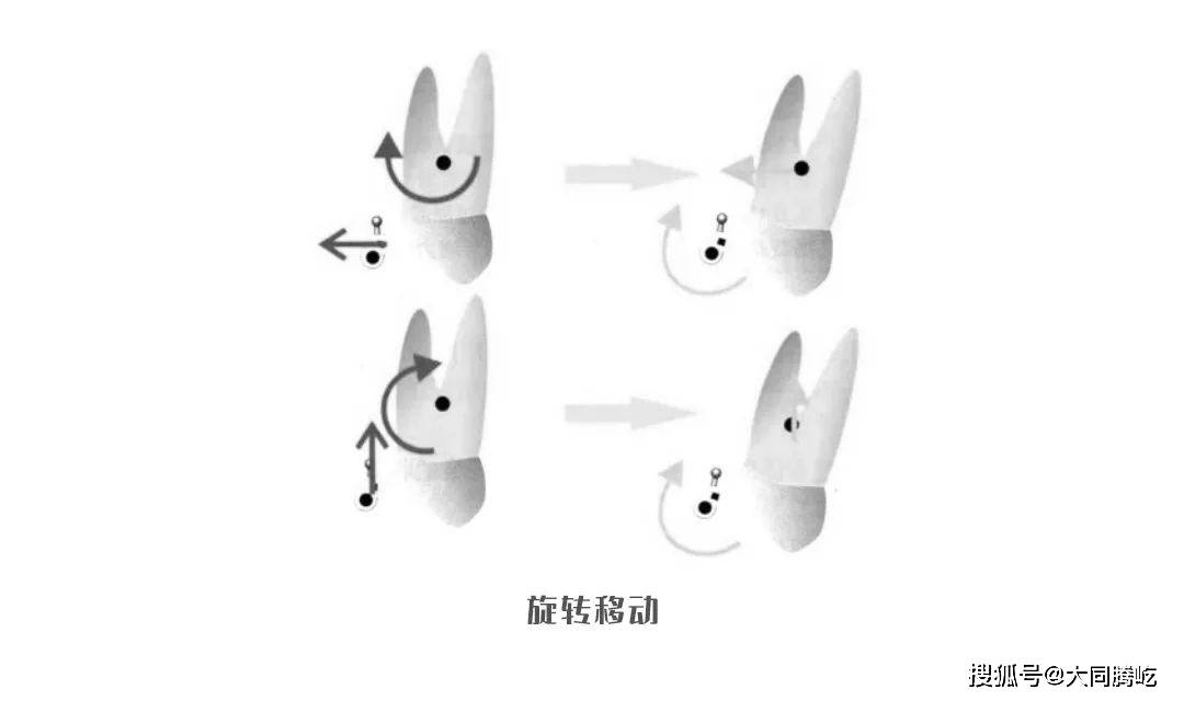 正畸牙齒旋轉移動示意圖