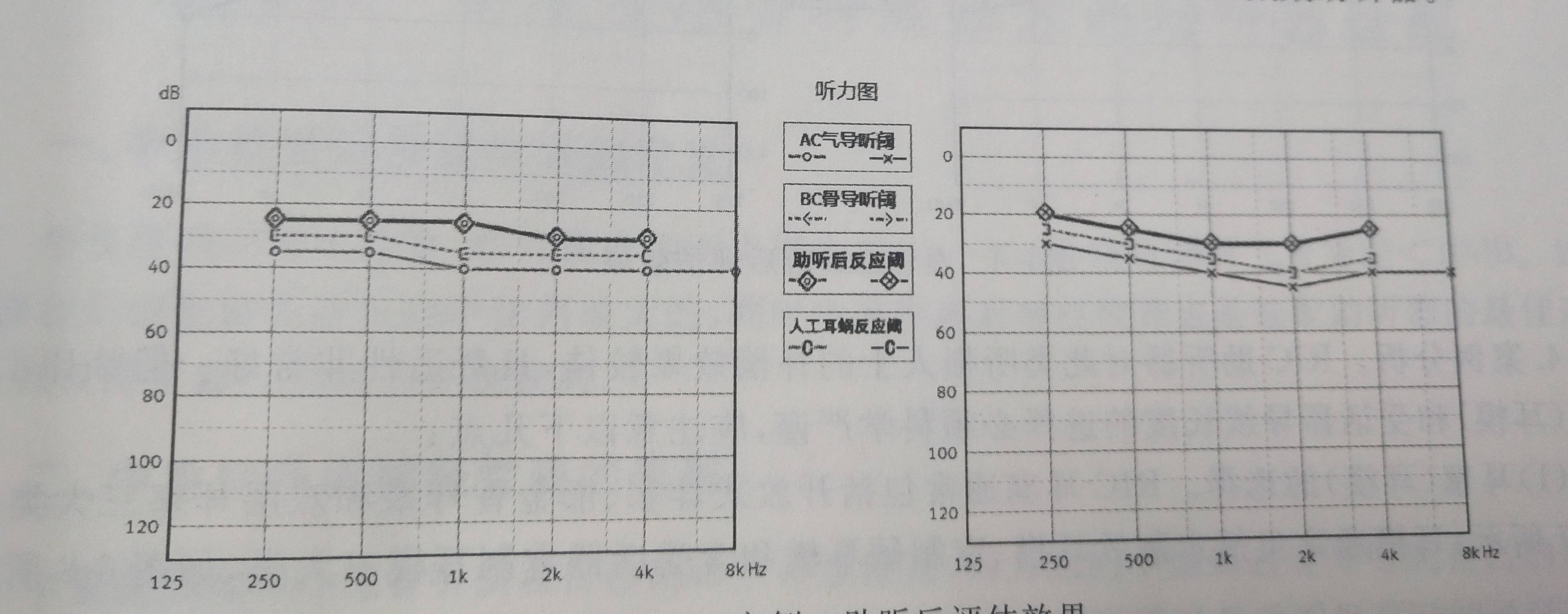 合川惠耳听力助听器—轻度感音神经性耳聋怎样验配助听器?