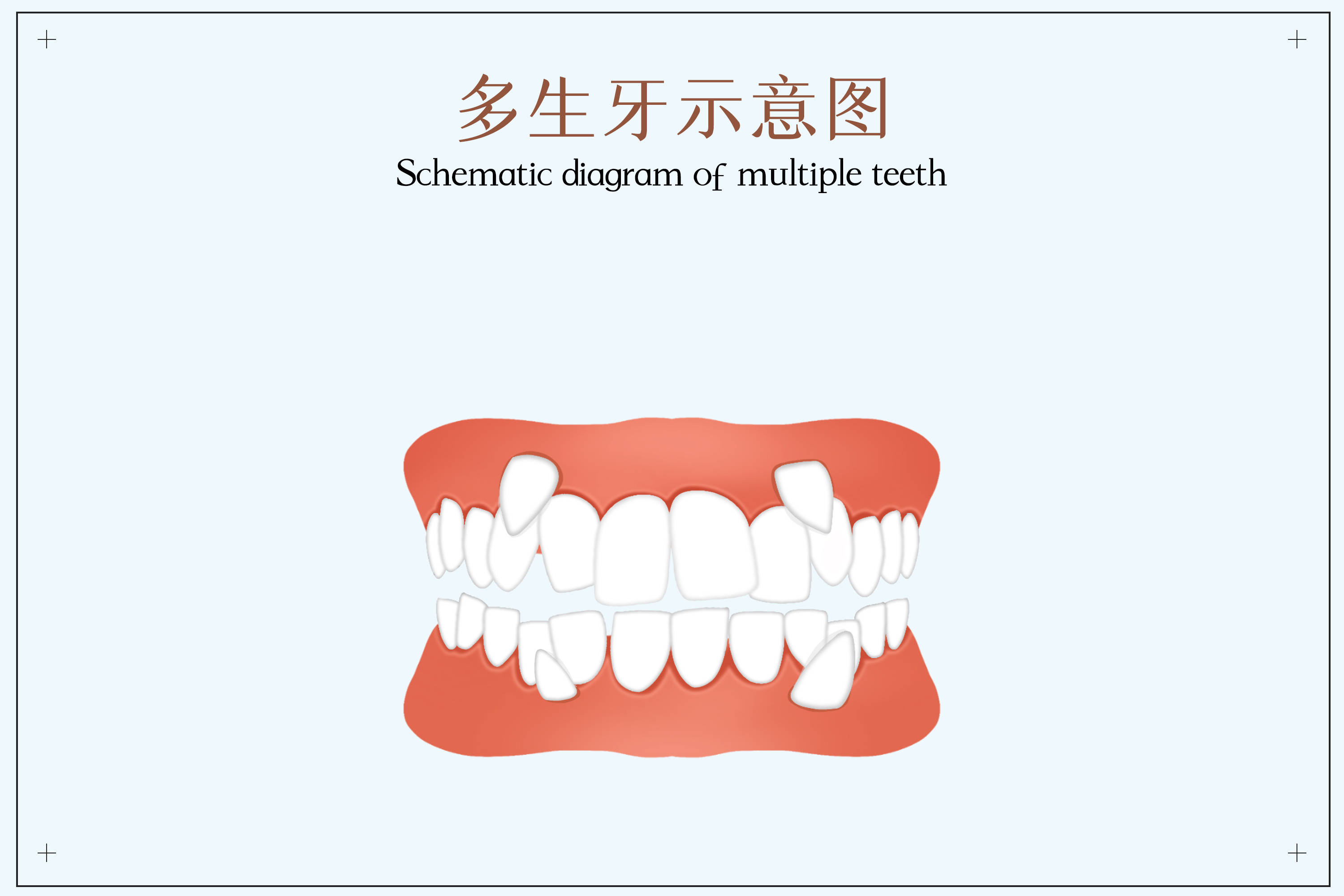 门牙内长了牙齿怎么办