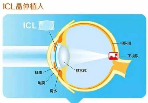 科视眼科 Icl手术 拯救高度近视 晶体