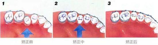 轮廓|圣嘉新邱立东：带牙套对改脸型手术有影响吗？