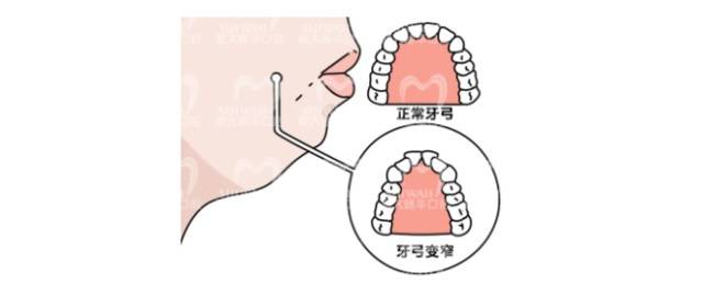 牙齿矫正中的扩弓器,是用来做什么的?
