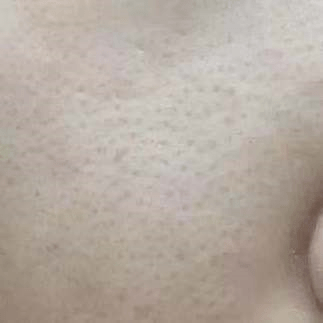 毛孔|毛孔粗大的姐妹们莫慌！你还有救!
