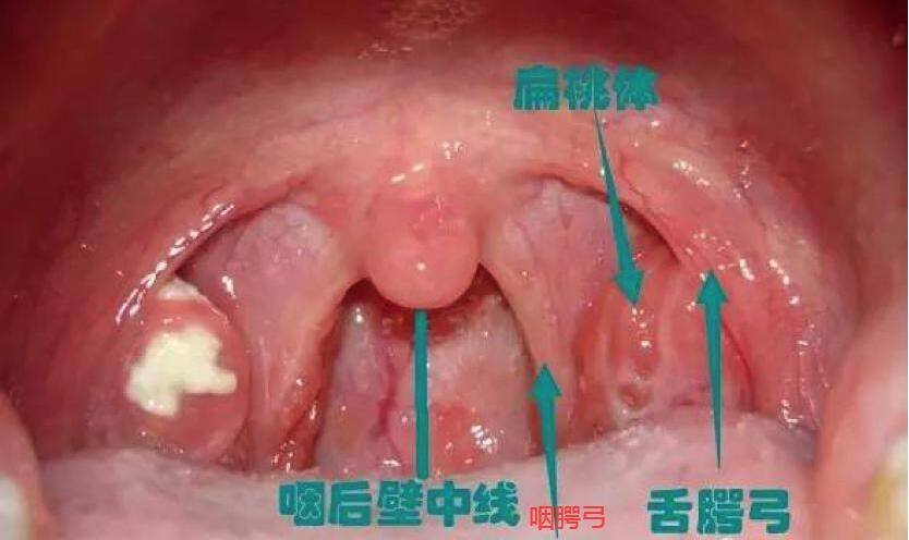 扁桃体三度肿大怎么办