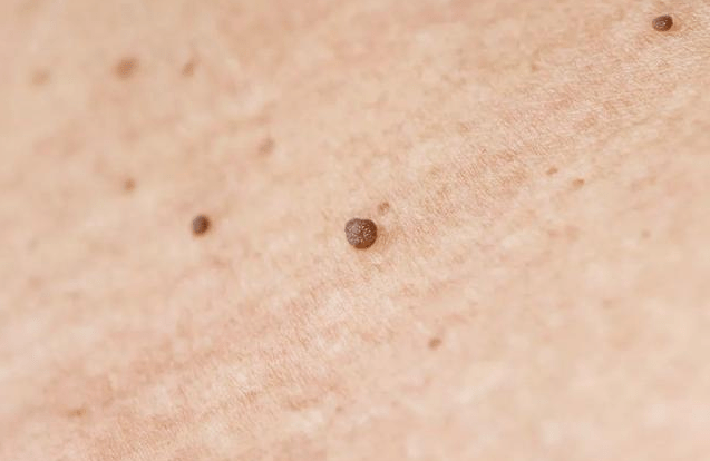 脖子周围长一些莫名的小肉疙瘩,形状细长突起,呈鸡冠状或菜花状,伴