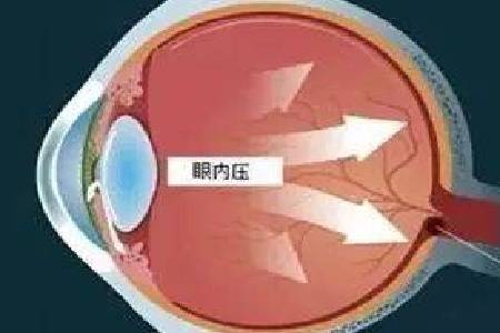 眼压检查能看出青光眼吗 d751e8d0bd91431695966168bb256218.jpeg