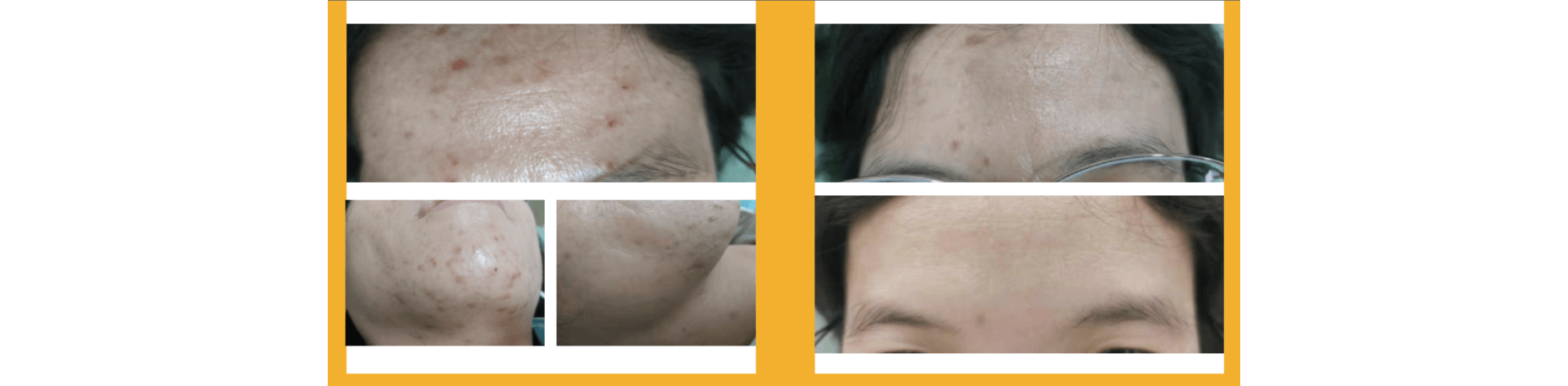 知识科普|透析变黑？越来越黑？听听肾友们怎么说