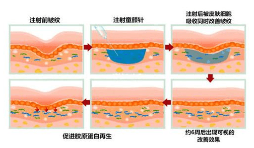 porea|PLLA膜与PLLA童颜针，到底有什么区别？