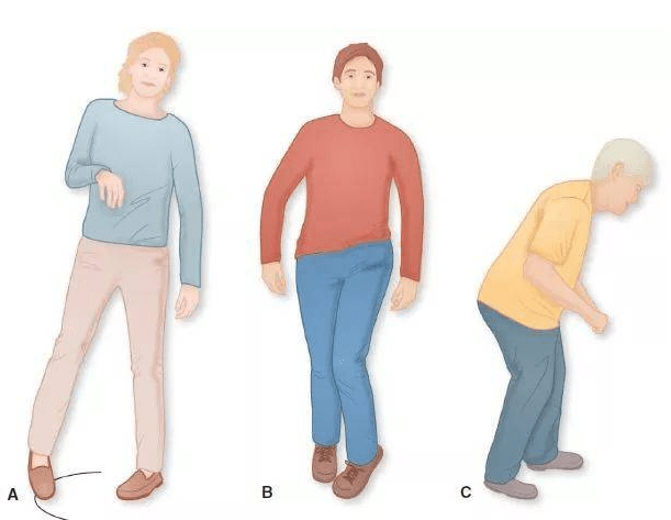 课堂|【康复课堂】为什么偏瘫患者要避免过早步行训练？容易造成哪些问题？