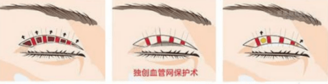 朋友|为了美丽，对自己下手“狠的人”真的很多，达芬奇定制美眼为啥她点名了非要做