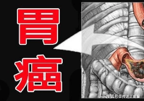 体内胃癌,饭后先知!若有这3"异常",必须引起重视