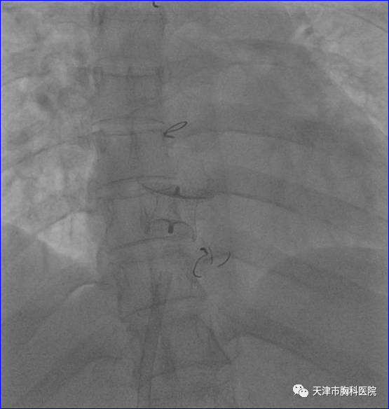 胸科医院|这种疾病只能开胸治疗？天津首例下腔型房间隔缺损介入封堵术在胸科医院完成！