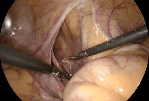 输尿管|这疝实属罕见！天津市人民医院成功为输尿管坐骨大孔疝患者实施腹腔镜微创术