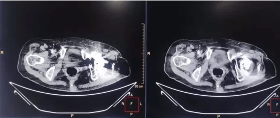 髋关节|影像检查遭遇金属植入物怎么办？三中心放射科巧妙解决“金属伪影”