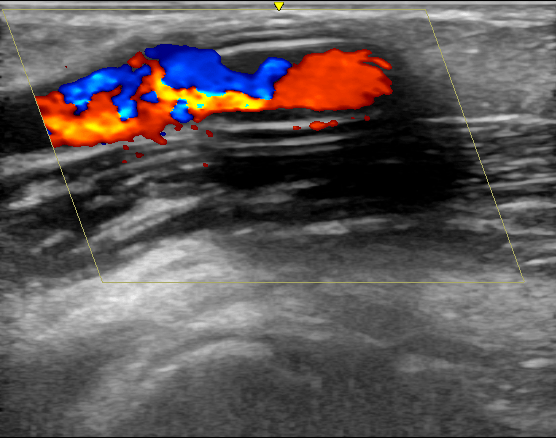 覆膜|西安交大一附院肾脏内科实施陕西省首例超声引导下透析通路支架植入术