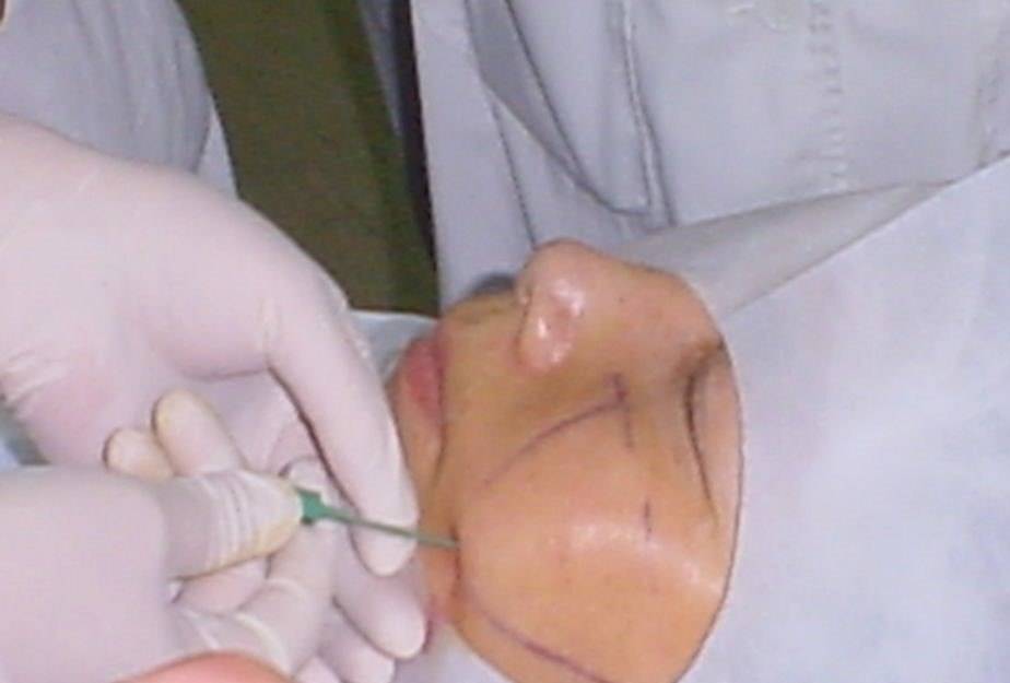 麻痹阻滞神经,以此来达到消炎,镇痛的目的