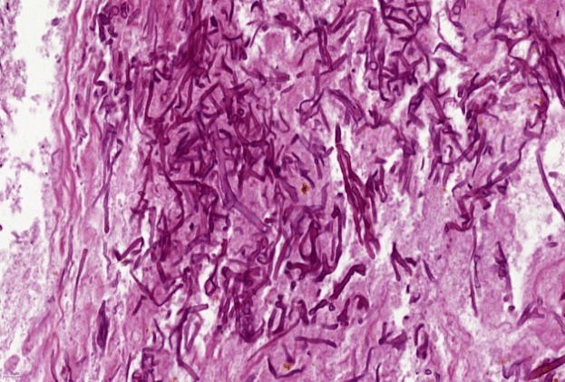 灌注|全身+局部 介入+灌注，清华长庚呼吸科治愈顽疾“肺毛霉菌病”