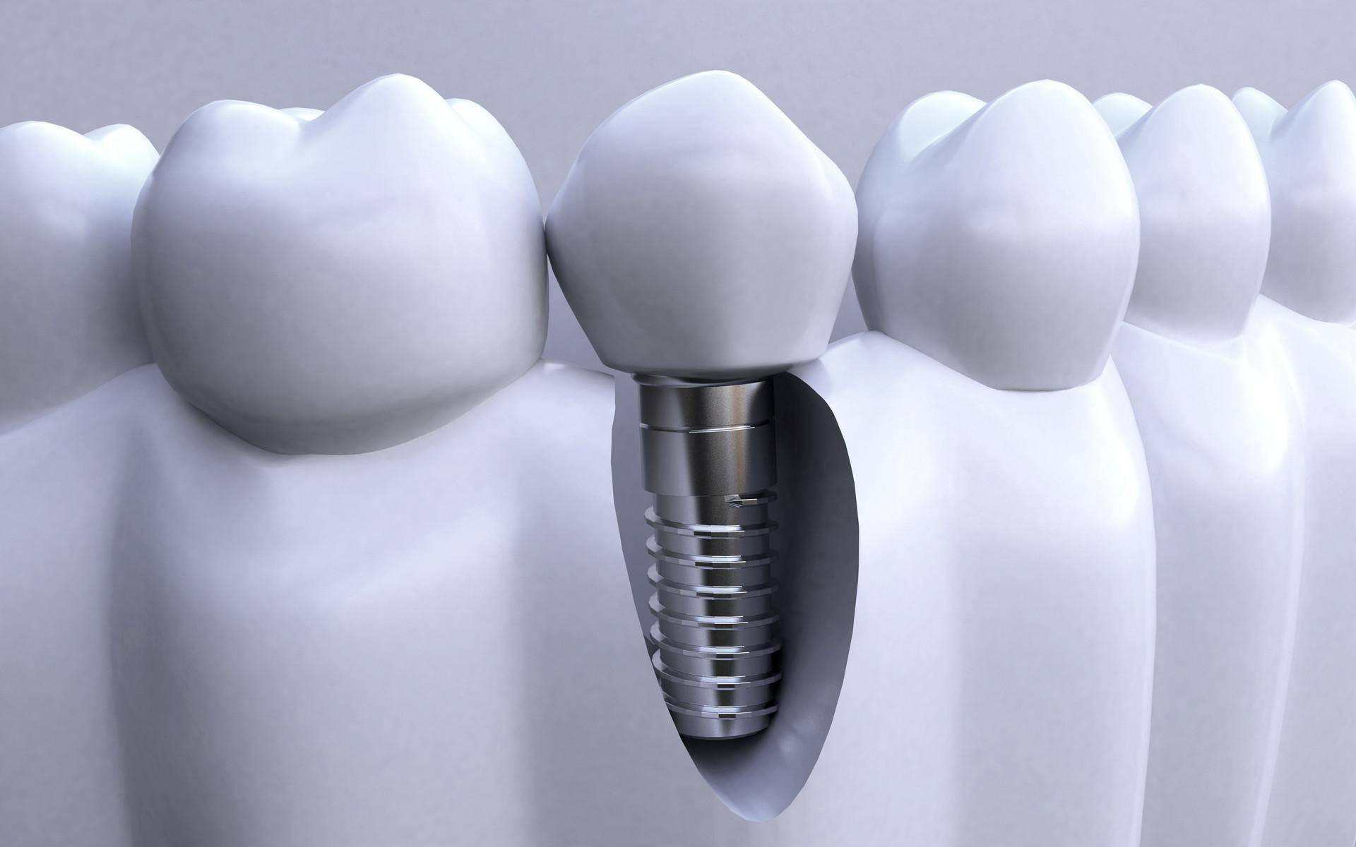 福清种植牙:影响种植牙寿命的因素都有哪些?优贝口腔带你了解