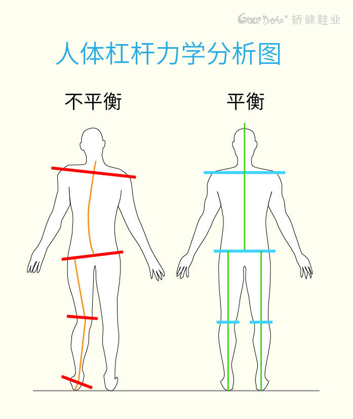如果足弓出现异常,会导致身体的重力线发生偏移,从而产生步态异常(内