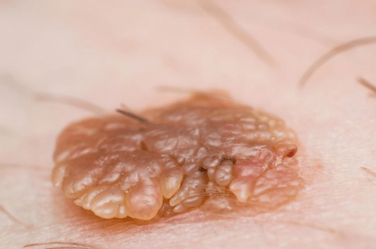 女性鸡冠状疣初期图片图片