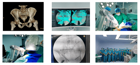 骨科 骨盆 青岛大学附属医院平度院区创伤外科成功开展骨科机器人微创治疗多发骨盆骨折