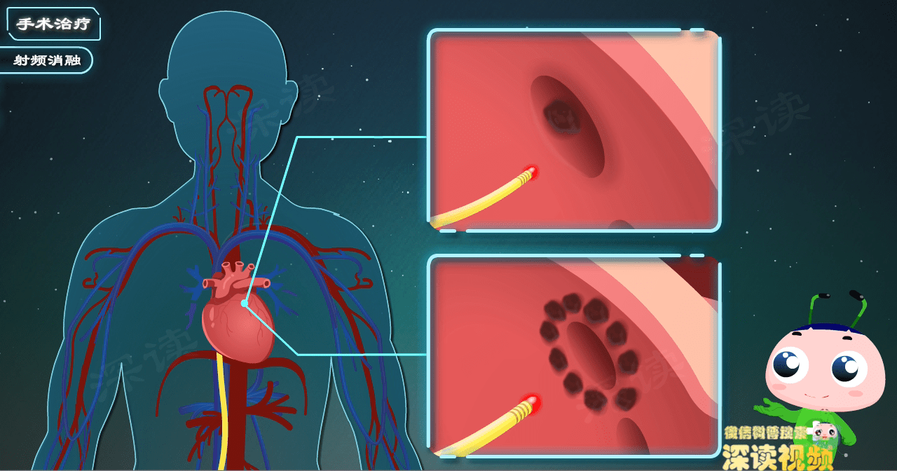 原创射频消融?杂交手术?外科迷宫手术?谁才能安全有效根治房颤?