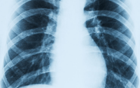 胸痛|肺炎的预防措施 肺炎的主要症状