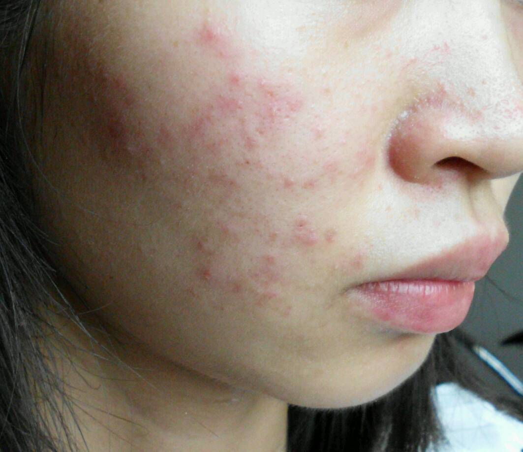 湿疹还能用药物治疗痊愈吗