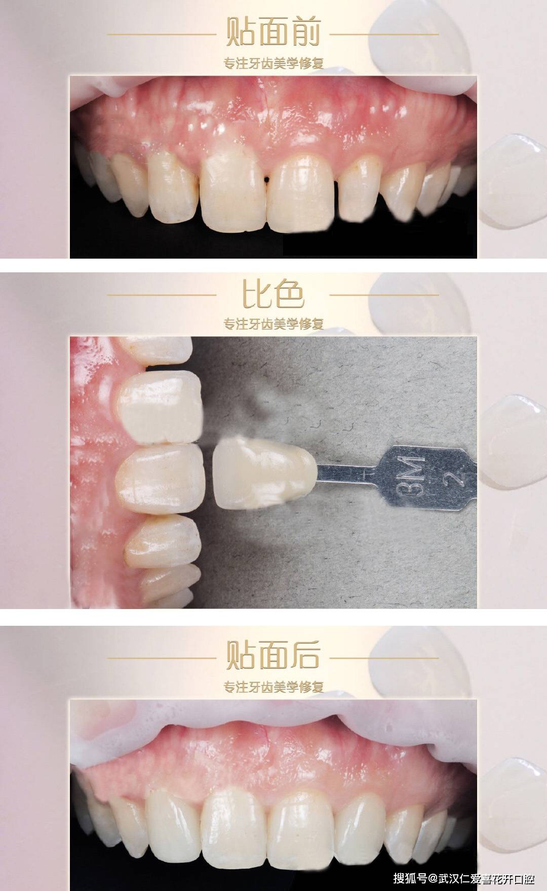 新兴的牙齿美容革命：全瓷牙贴面的时代